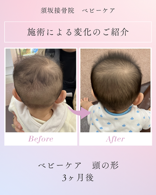 <span class="title">赤ちゃんの頭の形ケアの施術を開始して３か月</span>